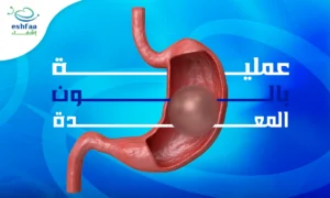 عملية بالون المعدة