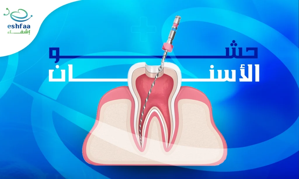 حشو-الأسنان