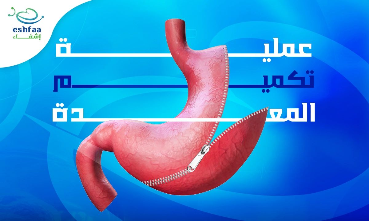 مميزات عملية تكميم المعدة